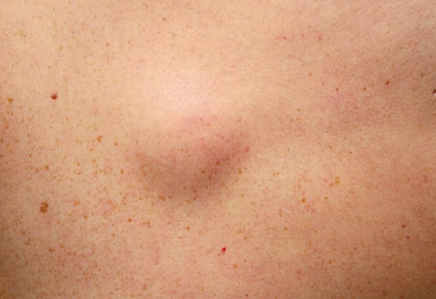 lipome sous la peau